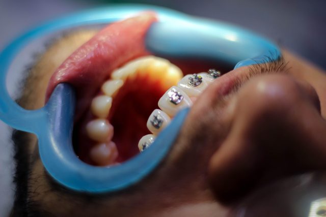 Close-up of orthodontics braces on teeth during a dental treatment session in Adelaide.